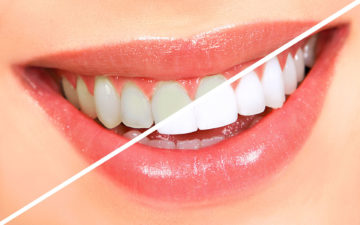 Smile Makeover